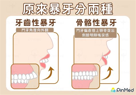 暴牙 面相